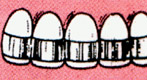 Irregular or malformed permanent teeth